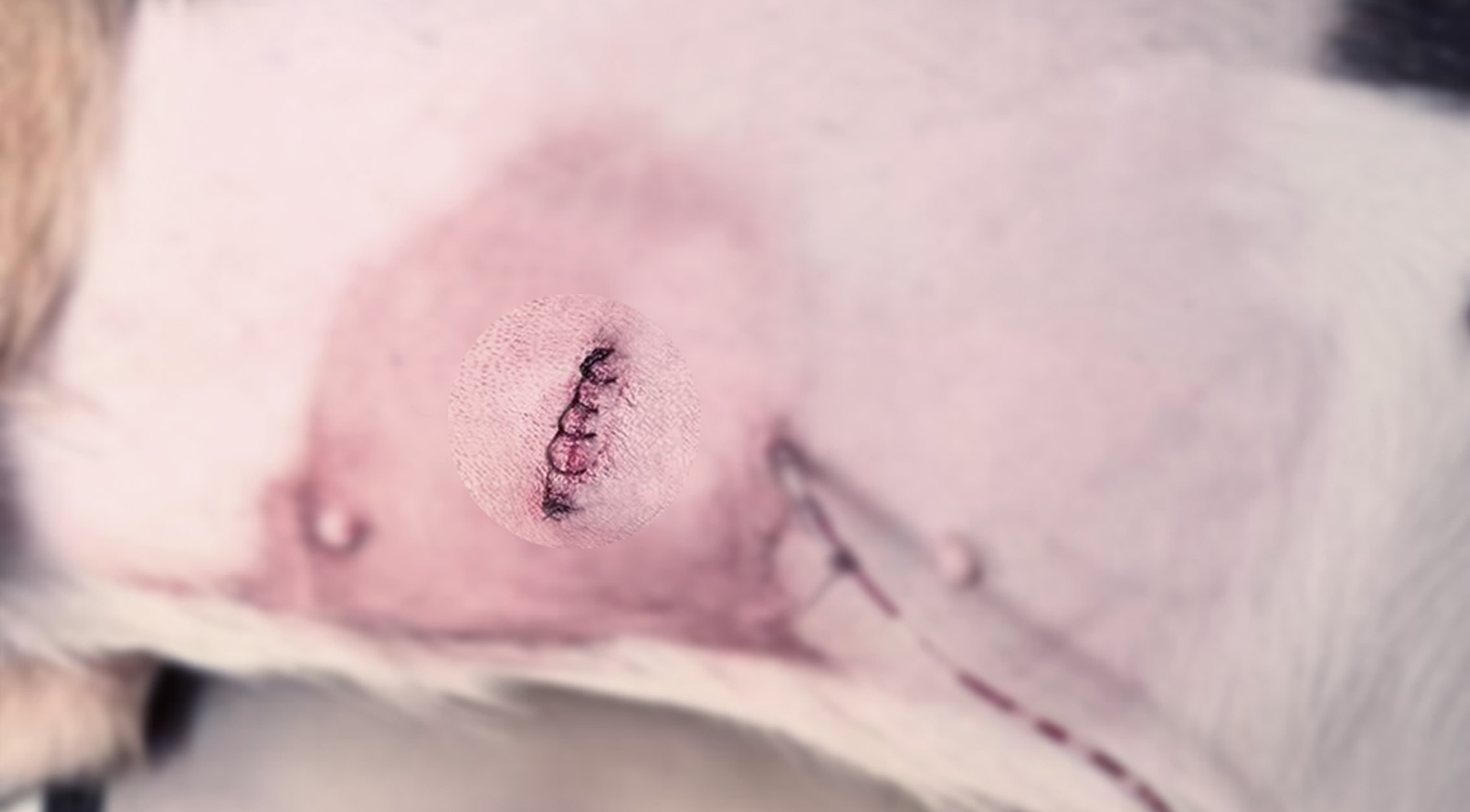 Minimally invasive advantages